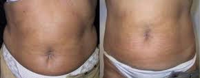 Abdomen after 4 treatments